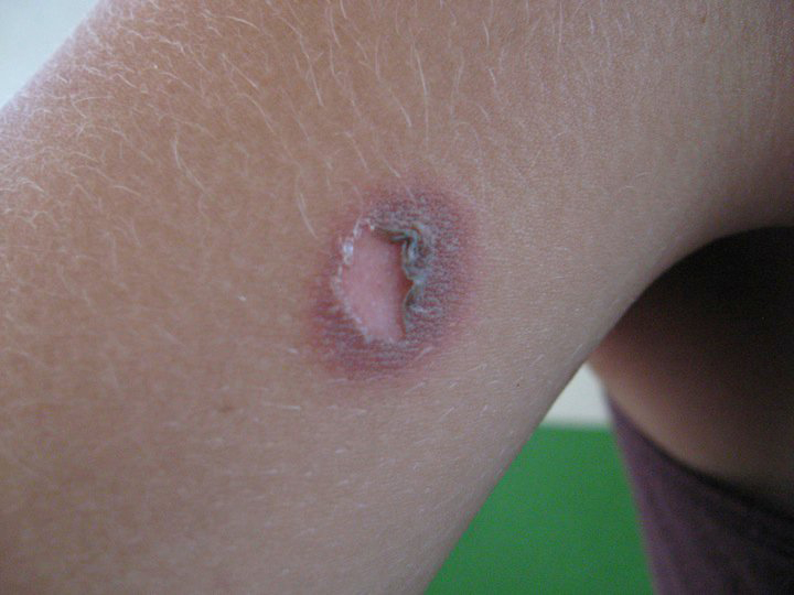 What Is Carpet Beetle Dermatitis Two Birds Home