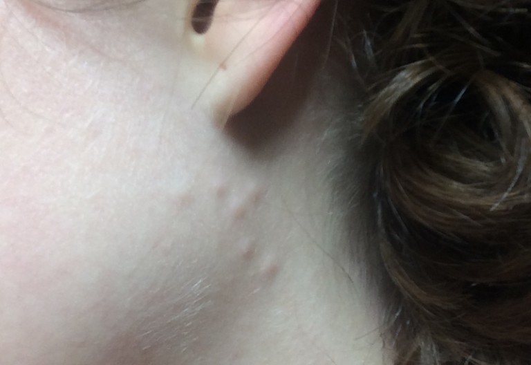 Varied Carpet Beetle and Bed Bug in bed and bumps on back and neck