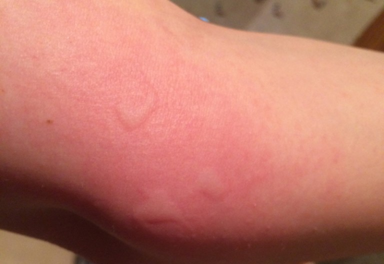 Can Bed Bugs Bite Through Clothes? Debunking Myths What's That Bug?